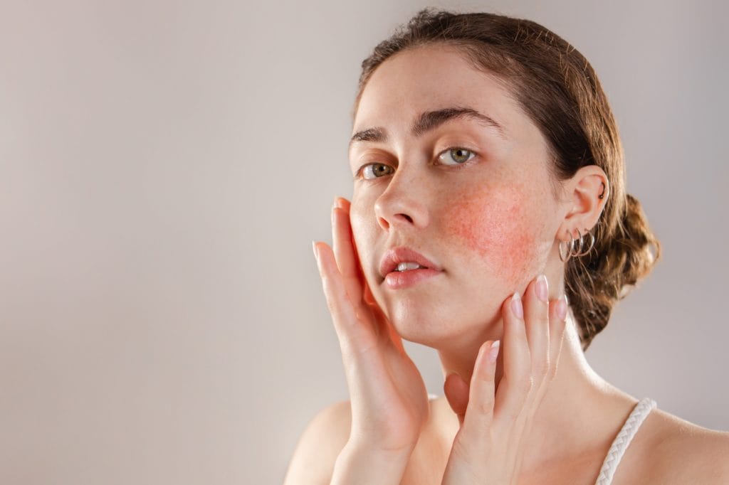 Medicine and cosmetology woman cheeks with rosacea | Outer Banks Dermatology in Nags Head, NC