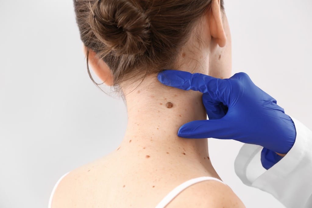 Mole removal | Outer Banks Dermatology | Nags Head, NC