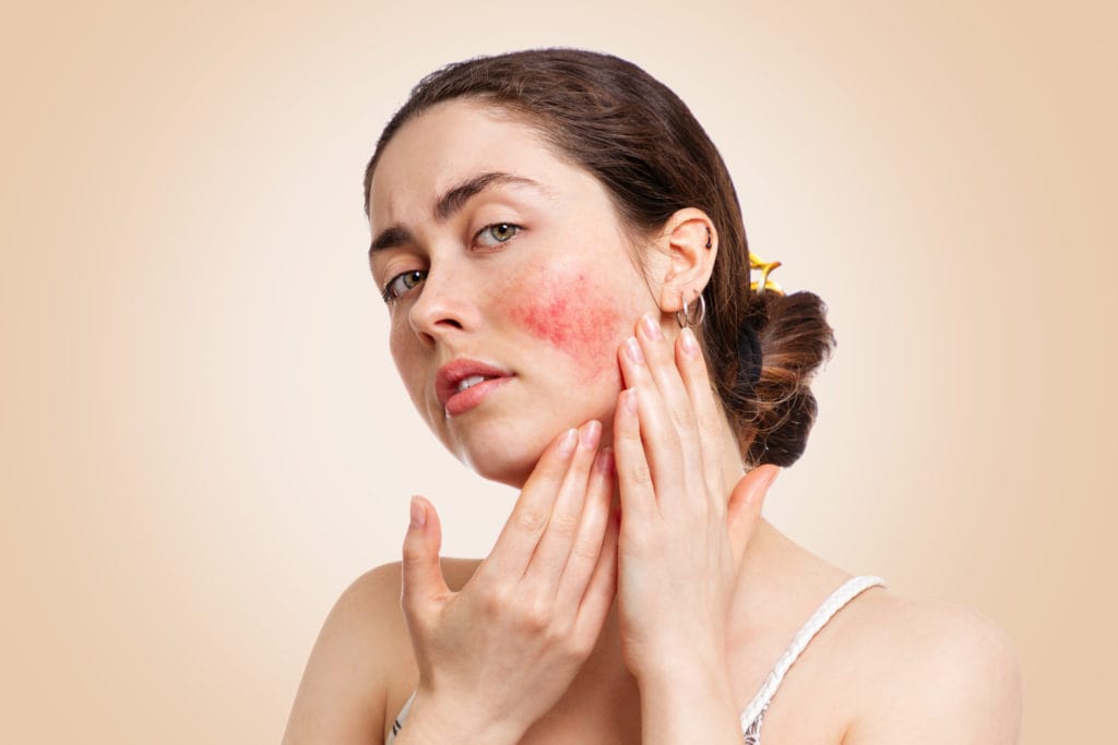 Rosacea | Outer Banks Dermatology