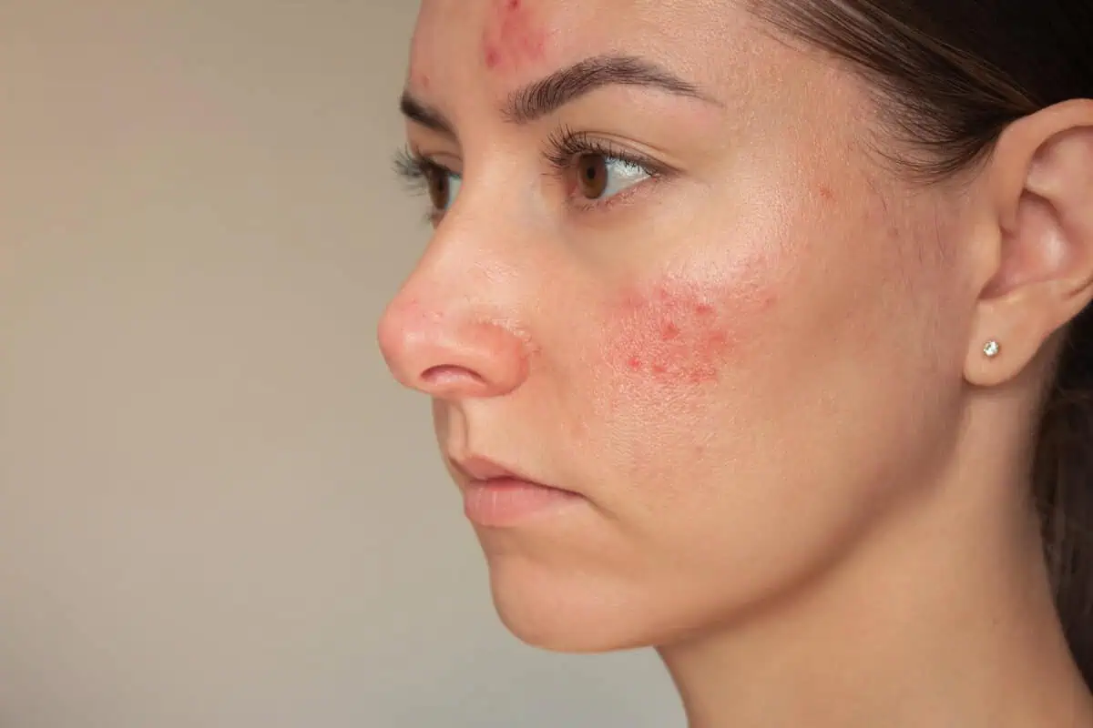 Rosacea by Outer Banks Dermatology in Nags Head NC