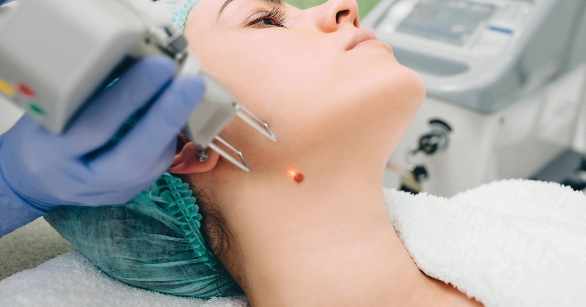 Women taking Mole Removal IN NAGS HEAD, NC
