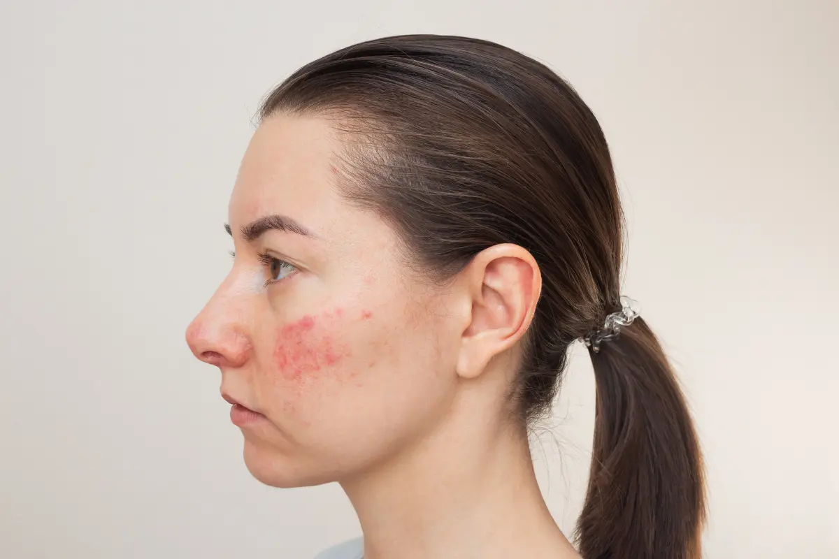 Woman with facial redness seeking Rosacea Treatment in Nags Head, NC