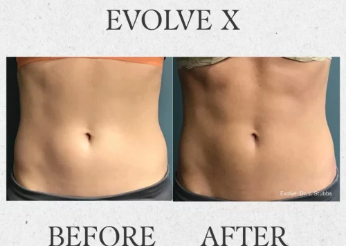 Outer Banks Dermatology before & after