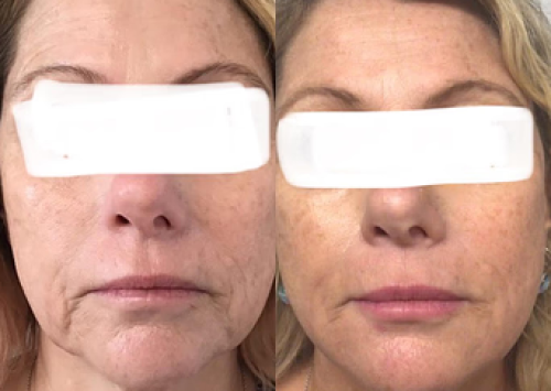 Outer-bank-dermology-gallery-botox-and-fillers