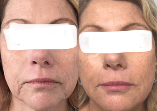 Botox and Fillers Images | Outer Banks Dermatology | Nags Head, NC