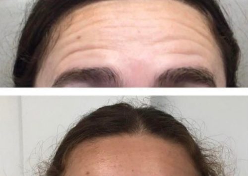 Botox Forehead Images | Outer Banks Dermatology | Nags Head, NC