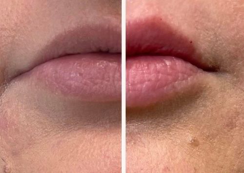 Botox Lip flip Images | Outer Banks Dermatology | Nags Head, NC