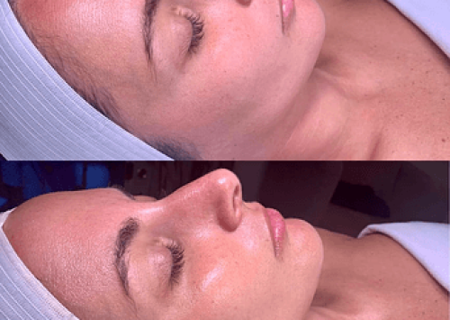 Hydrafacial Before and After| Outer Banks Dermatology | Nags Head, NC