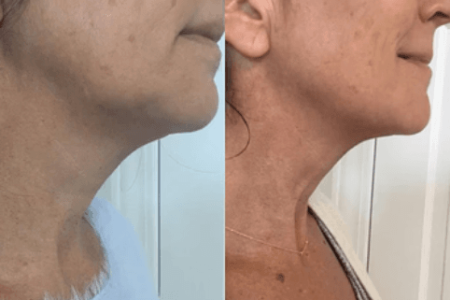 Kybella Images | Outer Banks Dermatology | Nags Head, NC