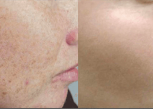 Rosacea Images | Outer Banks Dermatology | Nags Head, NC