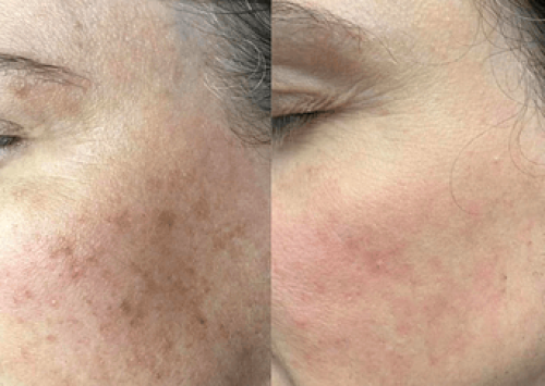 Acne scars Images | Outer Banks Dermatology | Nags Head, NC