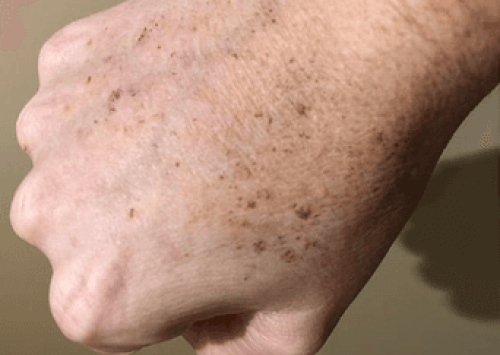 Eczema Images | Outer Banks Dermatology | Nags Head, NC