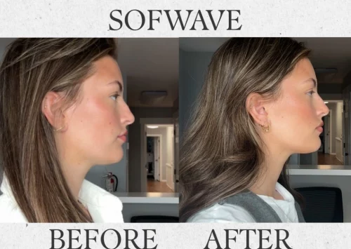 sofwave before & after