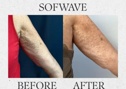 sofwave before & after