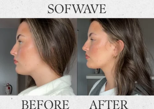 sofwave before & after